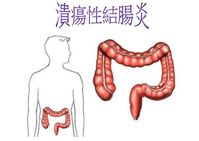 结肠炎治疗