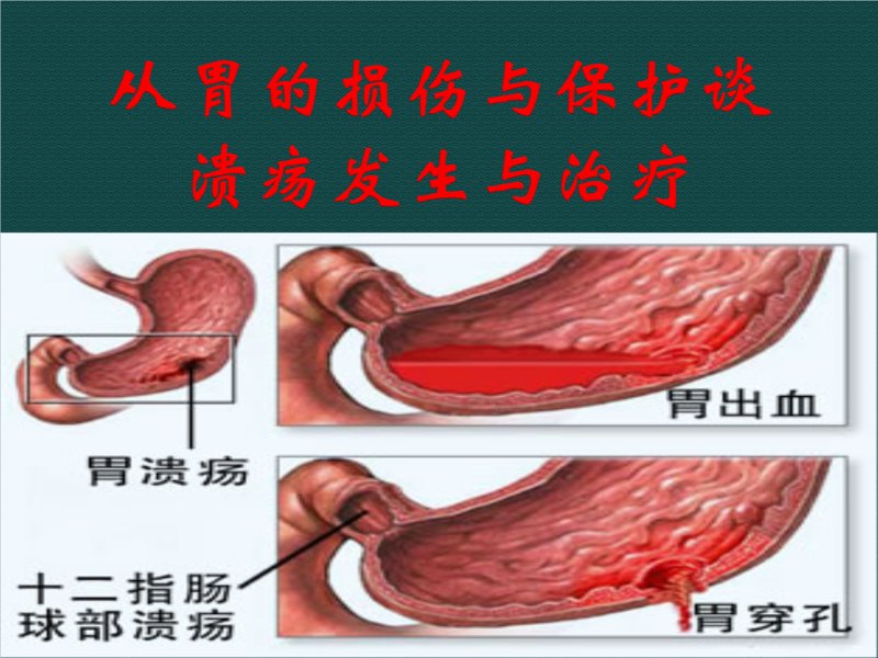 胃溃疡治疗